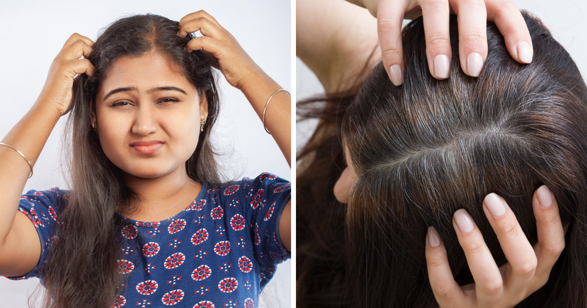 These 5 easy tips will give you relief from dandruff in 20 minutes