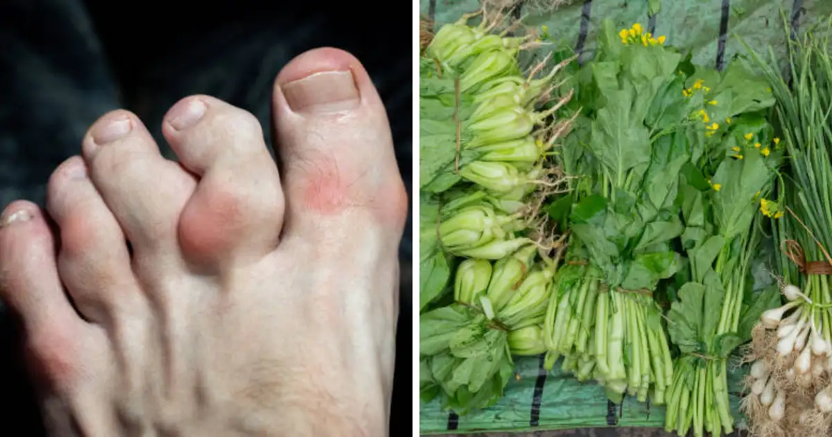 Purine Rich Green Vegetable Increase Uric Acid Level In Blood Home Remedies For Gout Arthritis