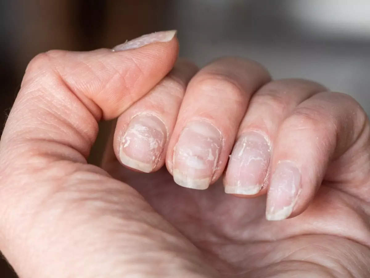 From physical factors, iron deficiency in the thyroid: Weak nails as a  symptom - Shendet i Pergjithshem