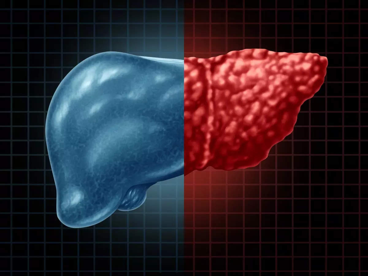 Non-alcoholic fatty liver disease: In order to keep the liver healthy in NAFLD.. this food must be consumed..!