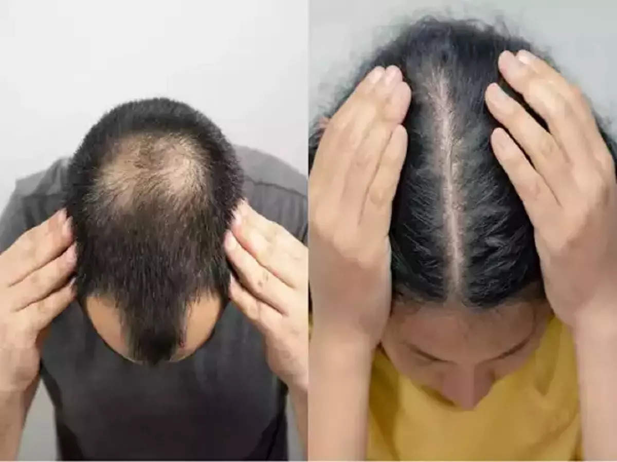 Male Hair Loss  Are You Need Treatment  Contact  adityanmsgmailcom   by Best Dermatologist In Madurai  Medium