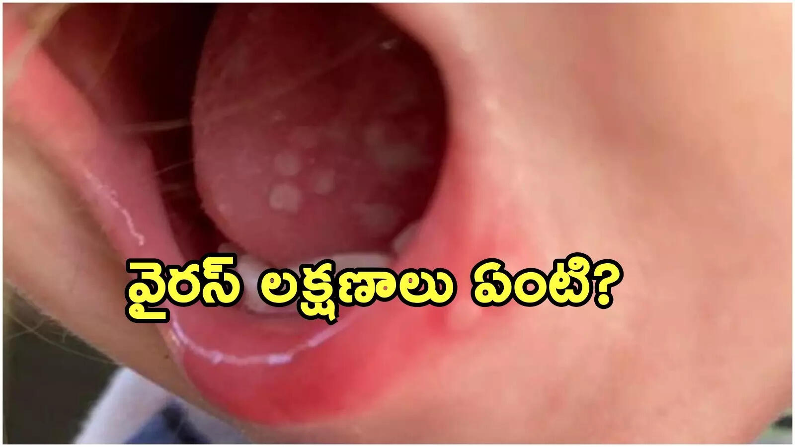 మరోసారి టమాటా వైరస్ కలకలం.. 12 ఏళ్లలోపు చిన్నారులు జరభద్రం