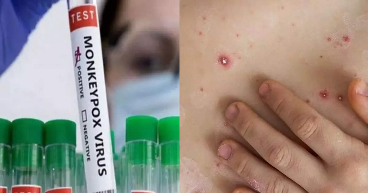 Mpox: Be careful! Fast spreading MPOX strain found in India, Health Ministry on alert