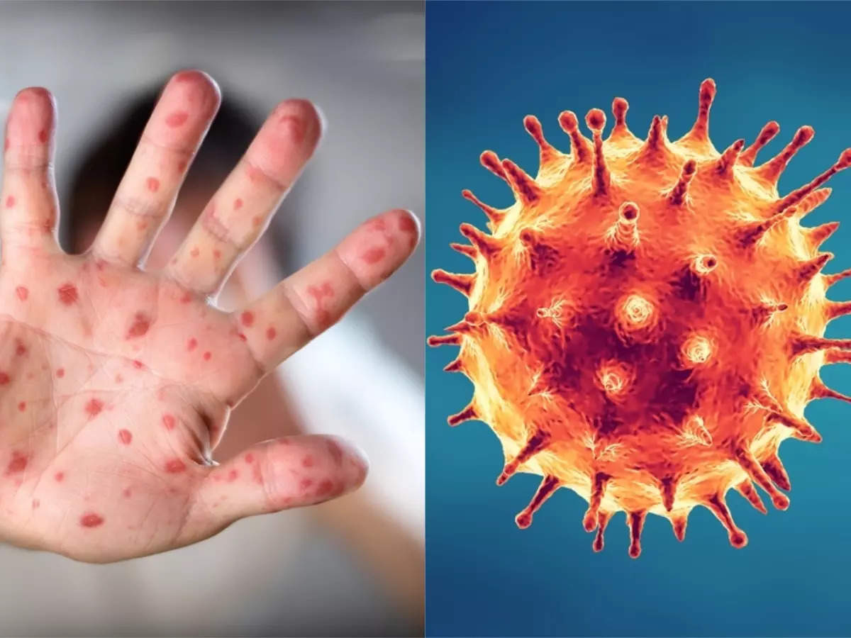 Monkeypox vs. Coronavirus How the two infections differ - कोरोना को टक्कर  देता हुआ 30 देशों में फैला मंकीपॉक्स, मिलते-जुलते हैं दोनों के लक्षण, 5  तरीकों से करें पहचान