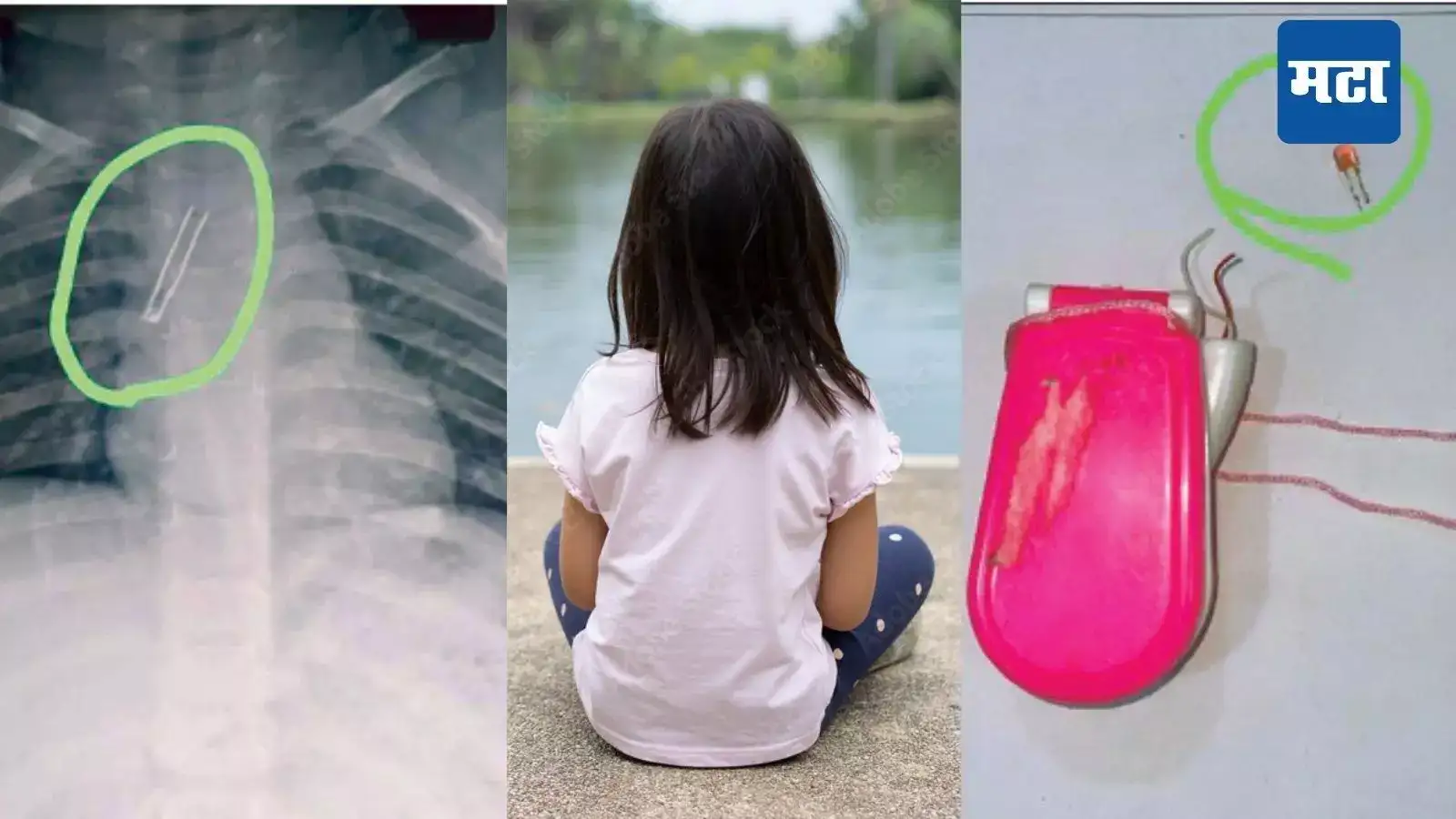 मुंबईतील चिमुरडीने मोबाईल तोंडात घातला, दम लागला, खोकला वाढला; डॉक्टरांकडे जाताच समजलं… मुंबईतील चिमुरडीने मोबाईल तोंडात घातला, दम लागला, खोकला वाढला; डॉक्टरांकडे जाताच समजलं…