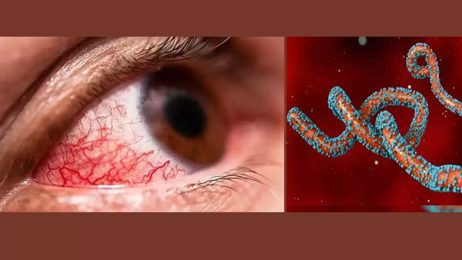 Bleeding eye Virus: கண்கள், மூக்கு, வாய் வழியாக வழியும் ரத்தம்.. மனித குலத்தை மிரட்டும் மார்பர்க் வைரஸ்.. 15 பேர் பலி! 