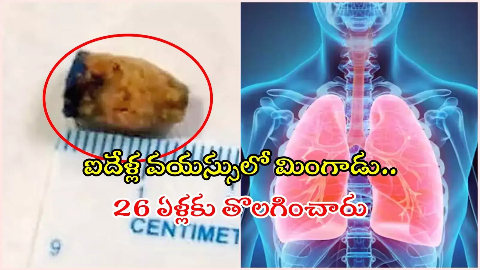 HYD: 21 ఏళ్లుగా ఊపిరితిత్తుల్లోనే పెన్‌ క్యాప్‌.. తొలగించిన కొండాపూర్ కిమ్స్‌ డాక్టర్లు