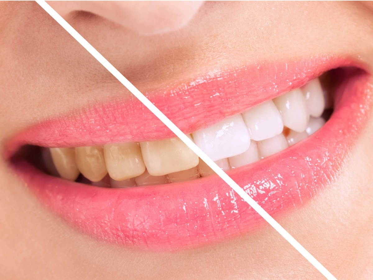 If you drink tea or coffee, do you stain your teeth quickly?
