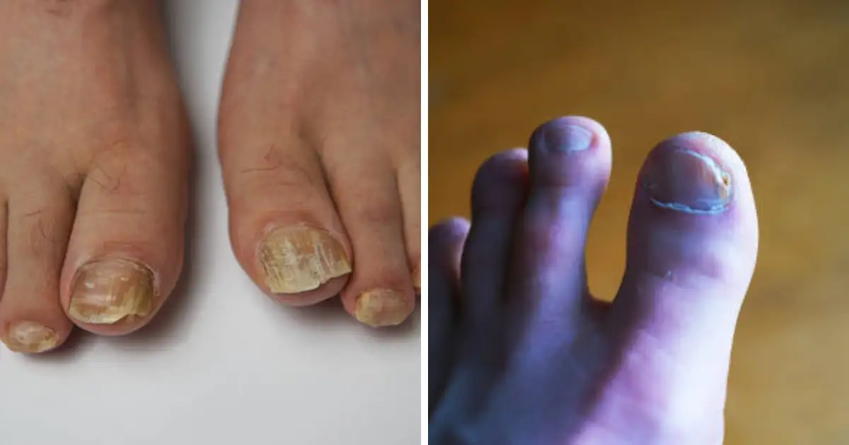 Nails Turning Black Reason,तुमच्या पायाच्या नखांवर काळी रेष येऊन नखे काळी पडत आहेत का? त्यामागे