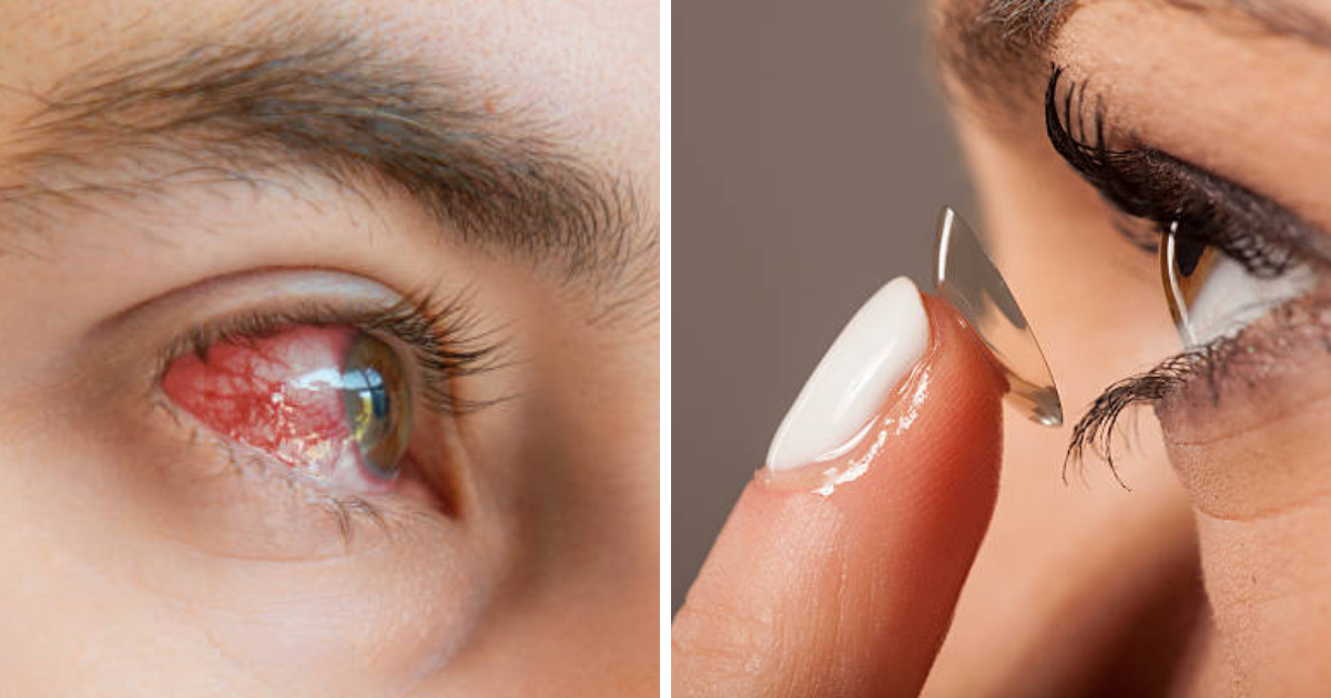 how can i get rid of red eyes without eye drops