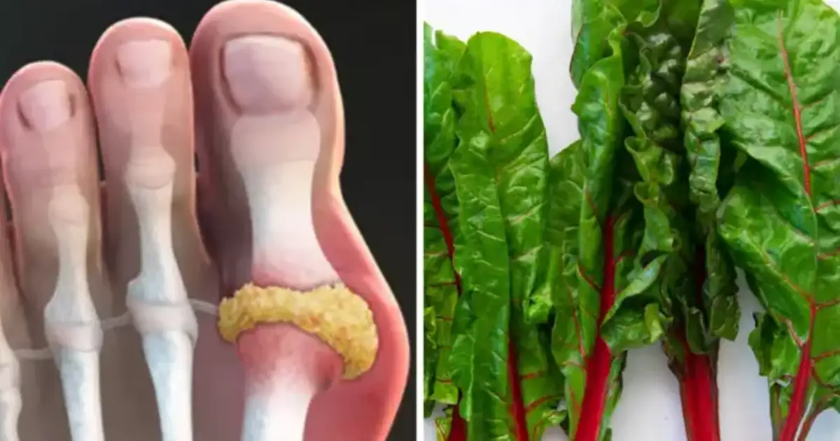 Eat These Leafy Vegetables Fruits Foods For Reduce Uric Acid And