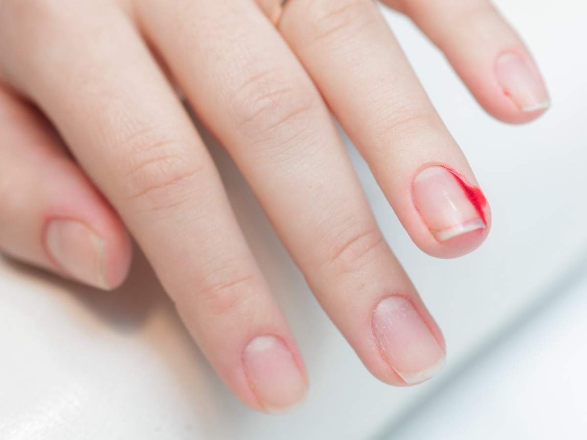 Fingernail Abnormalities That Can Signal Health Issues
