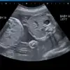 Can Twins Interact with Each Other in the Womb?