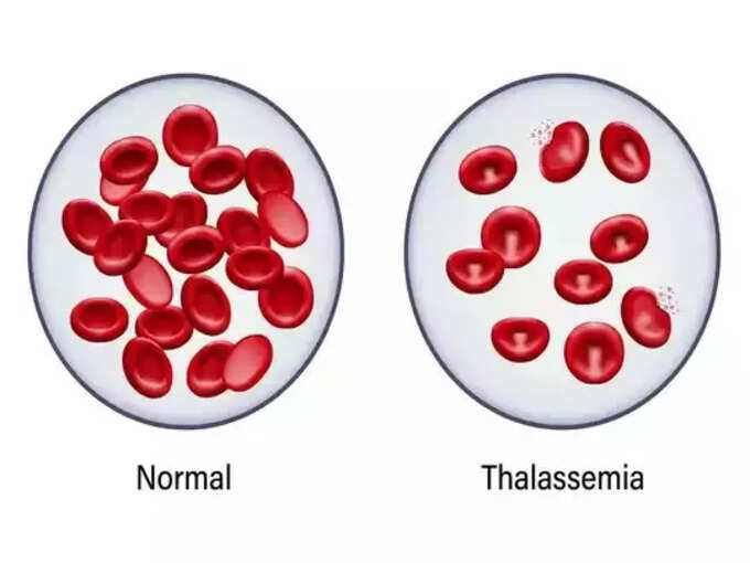 ​தாலசீமியா நோயாளிகளுக்கு இரத்தம் உற்பத்தி ஆகுமா?​