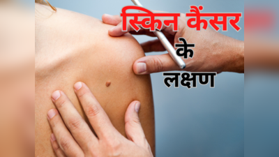 Symptoms Of Cancer In Birthmarks: कहीं आपके बर्थमार्क में कैंसर तो नहीं बन रहा? इन 5 लक्षणों से करें पहचान