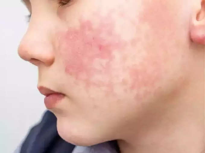 ​Inverse Psoriasis -தலைகீழ் சொரியாசிஸ்​