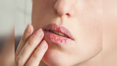 Chapped Lips in Summer: ভরা গরমেও ফাটছে ঠোঁট, চামড়া উঠে রক্তারক্তি? ছোট্ট এই কাজেই মিলবে সুরাহা