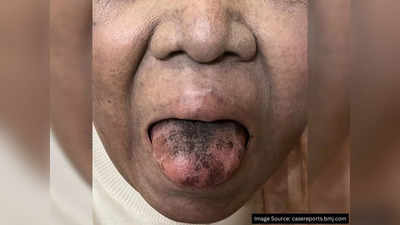 Woman Black Hairy Tongue: काली हो गई जीभ और उग आए बाल, महिला की हालत देखकर डॉक्टर भी हैरान हो गए
