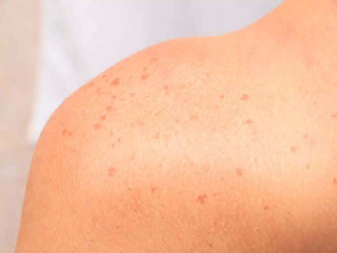 Can birthmarks cause skin cancer? Recognize by these 5 symptoms | Hits Times What to do if you experience symptoms