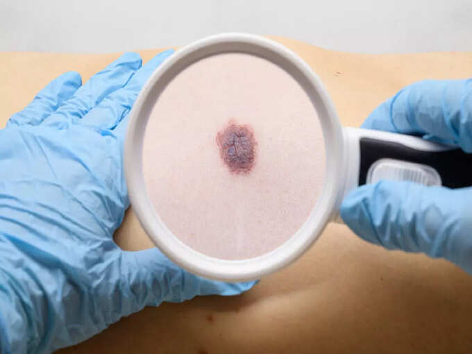Can birthmarks cause skin cancer? Recognize by these 5 symptoms | Hits Times Boundary or border line