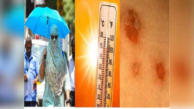 Mumbai News: उष्णतेमुळे मुंबईत पसरतोय त्वचेचा हा आजार, अंगावर पुरळ आल्यास तातडीने डॉक्टरांना गाठा