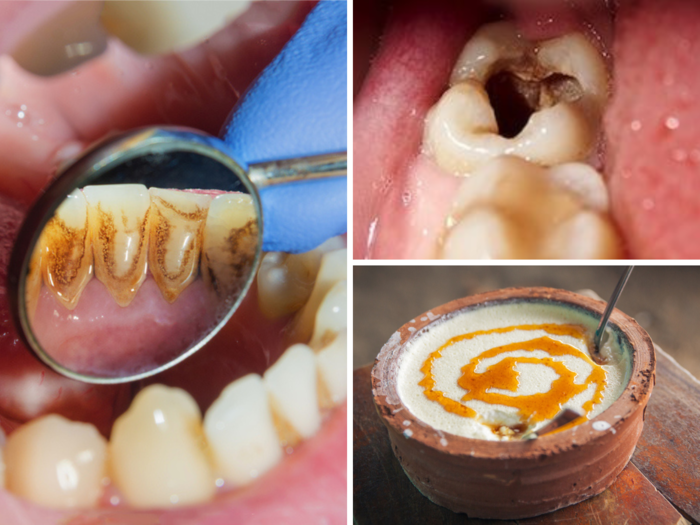 5 effective home remedies to get rid of cavity, dental plaque, tartar, tooth decay, bad breath smell