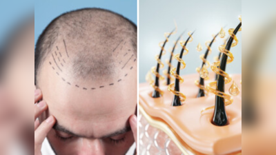 Hair Transplant Precautions: हेअर ट्रान्सप्लांट करण्याआधी या गोष्टींची घ्या काळजी, लक्षात ठेवा