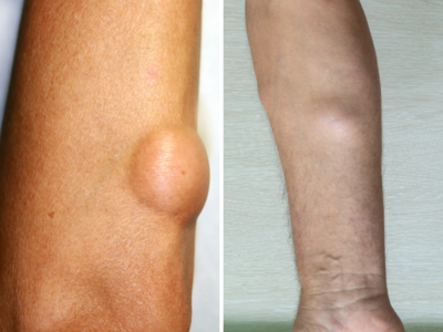 Lipomas Causes: हाथ-पैर में मौजूद छोटी-छोटी गांठ है कैंसर? डॉ. ने बताया बिना खर्च का इलाज