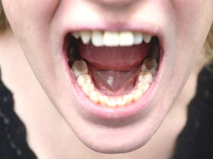 3.  The health of the inside of the mouth returns