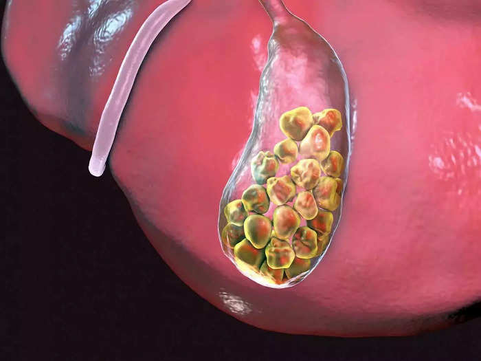 how to dissolve 13.5mm gallstones without surgery, dr told best treatment and symptoms