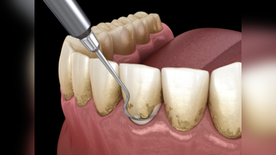 दांतों में कीड़े और सड़न से भी होता है Oral Cancer, सीनियर डॉक्टर बोले- लापरवाही बरती तो भुगतेंगे परिणाम