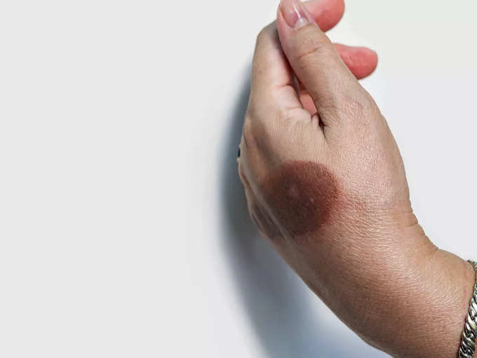 1. What to do if burned? 1. What to do if burned?