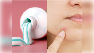 Pimple Remedies: ಮೊಡವೆಗಳಿಗೆ ಟೂತ್‌ಪೇಸ್ಟ್ ಹಚ್ಚೋದ್ರಿಂದ ಪಿಂಪಲ್ಸ್‌ ಮಾಯವಾಗುತ್ತಾ?