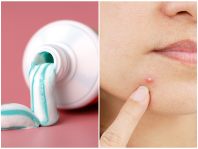 Pimple Remedies: ಮೊಡವೆಗಳಿಗೆ ಟೂತ್‌ಪೇಸ್ಟ್ ಹಚ್ಚೋದ್ರಿಂದ ಪಿಂಪಲ್ಸ್‌ ಮಾಯವಾಗುತ್ತಾ?