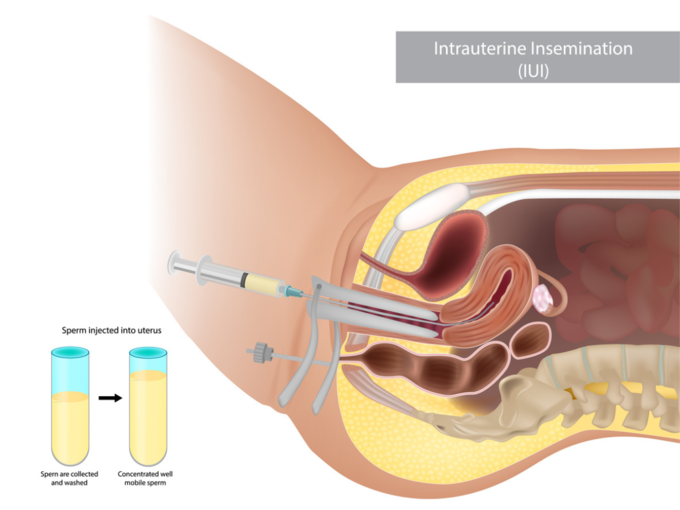 what happens in iui