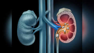 Kidney Stones: కిడ్నీలో రాళ్లు రాకుండా.. ఈ జాగ్రత్తలు పాటించండి..!