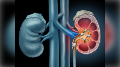 Kidney Stone Treatment: ಮೂತ್ರಪಿಂಡದ ಕಲ್ಲಿನ ಸಮಸ್ಯೆಯನ್ನು ತಡೆಗಟ್ಟಲು ಇಲ್ಲಿದೆ ಆಯುರ್ವೇದ ಪರಿಹಾರ