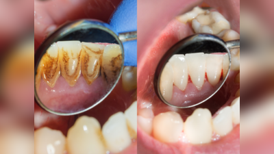 gingivitis : பற்களில் உள்ள விடாபிடியான கறைகளை ஒரே வாரத்துல சரிசெய்யணுமா... இந்த வீட்டு வைத்தியங்களை ட்ரை பண்ணுங்க...