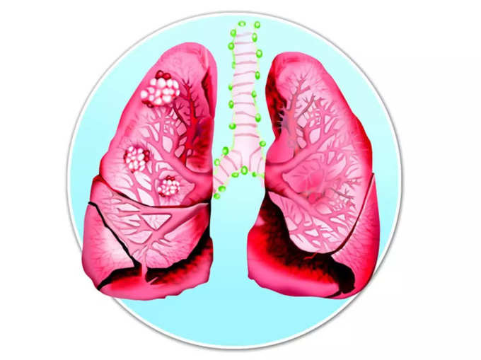 ​புகைப்பதால் Respiratory Disorders பிரச்சனைகள் வரலாம்​