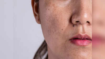 Tips To Remove Pigmentation: ​పిగ్మెంటేషన్‌ తగ్గాలంటే.. టమాటాలో ఇది కలిపి రాయండి..!