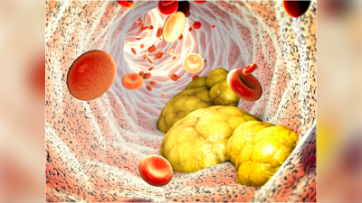 High Cholesterol: ಕಾಲಿನಲ್ಲೂ ಕಾಣಿಸಿಕೊಳ್ಳುತ್ತವಂತೆ ಅಧಿಕ ಕೊಲೆಸ್ಟ್ರಾಲ್‌ನ ಲಕ್ಷಣಗಳು