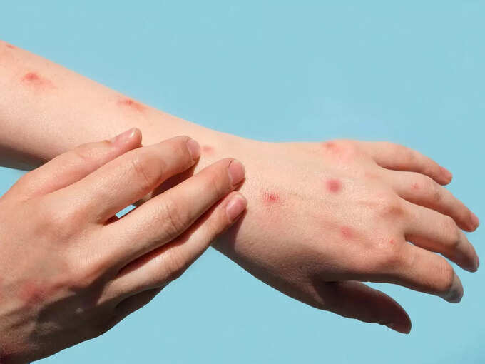 Able to prevent chicken pox Able to prevent chicken pox
