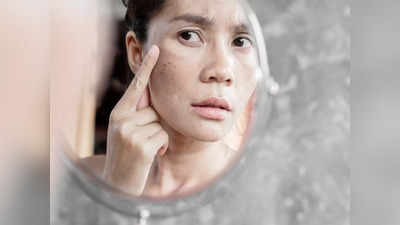 Tips to get rid of acne spots: మొటిమల మచ్చలు పోవాలంటే.. ఈ టిప్స్‌ ఫాలో అవ్వండి..!