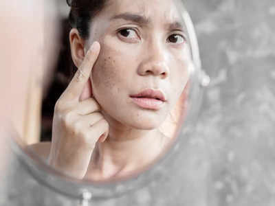 Tips to get rid of acne spots: మొటిమల మచ్చలు పోవాలంటే.. ఈ టిప్స్‌ ఫాలో అవ్వండి..!