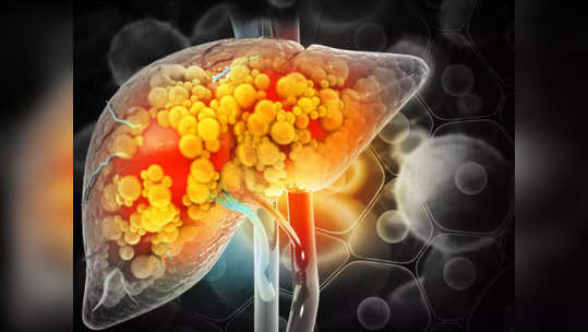 Fatty Liver : கல்லீரல் கொழுப்பு பிரச்சினை உள்ளவங்க எதெல்லாம் சாப்பிடலாம்... என்ன சாப்பிட கூடாது...