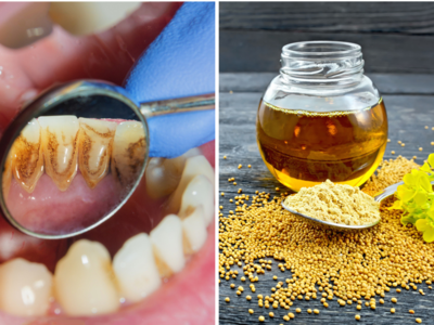 Teeth Whitening Home Remedies: दांतों की पीली परत होगी साफ, मोती जैसी चमकेगी बत्तीसी, तुरंत ले आएं ये 4 चीजें