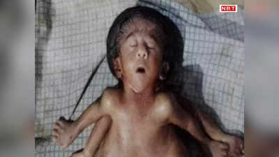 Bihar News: 4 हाथ-4 पैर, 2 दिल और एक सिर... छपरा के नर्सिंग होम में विचित्र बच्ची का जन्म, जिसे पता चला वो देखने चला आया