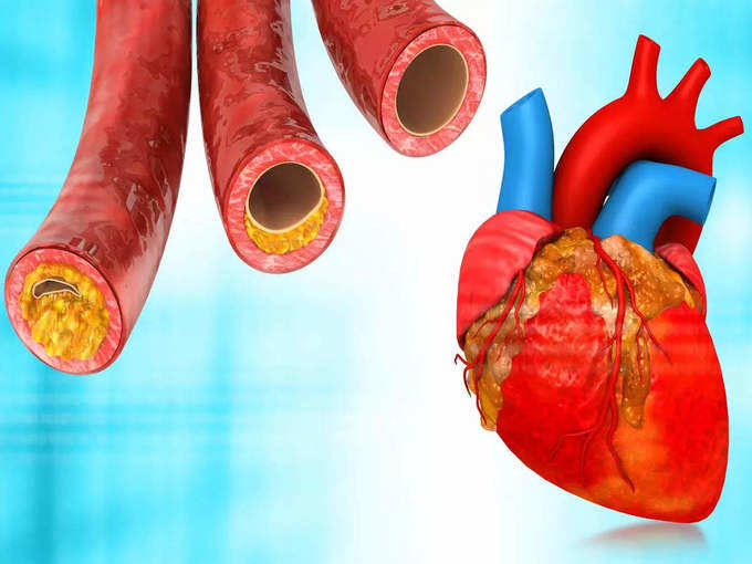 ​கரோனரி தமனி நோய் (coronary heart disease)