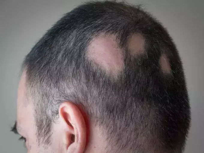 ​அலோபீசியா அரேட்டா (Alopecia areata)