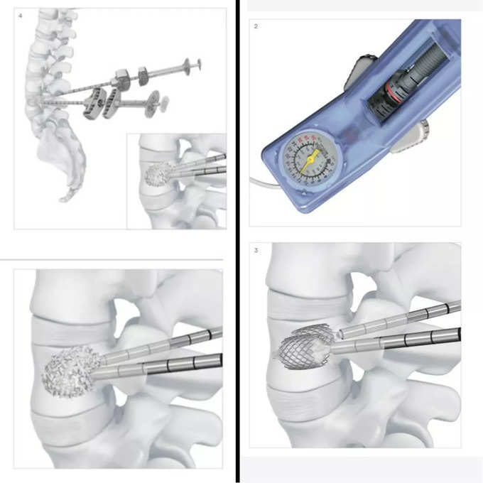 spinal surgery